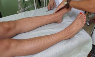 Pacientes en control (edema congénito + fx de pie)